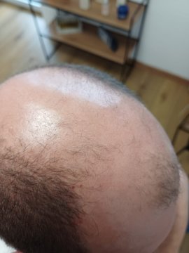 Androgénna alopécia – keď vlasy rednú vplyvom hormónov a genetiky