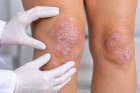 Psoriáza