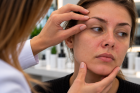 Seboroická dermatitída