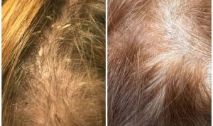 SEBOREA (SEBOROICKÁ DERMATITÍDA)