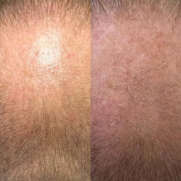 ANDROGÉNNA ALOPÉCIA (PLEŠATOSŤ)