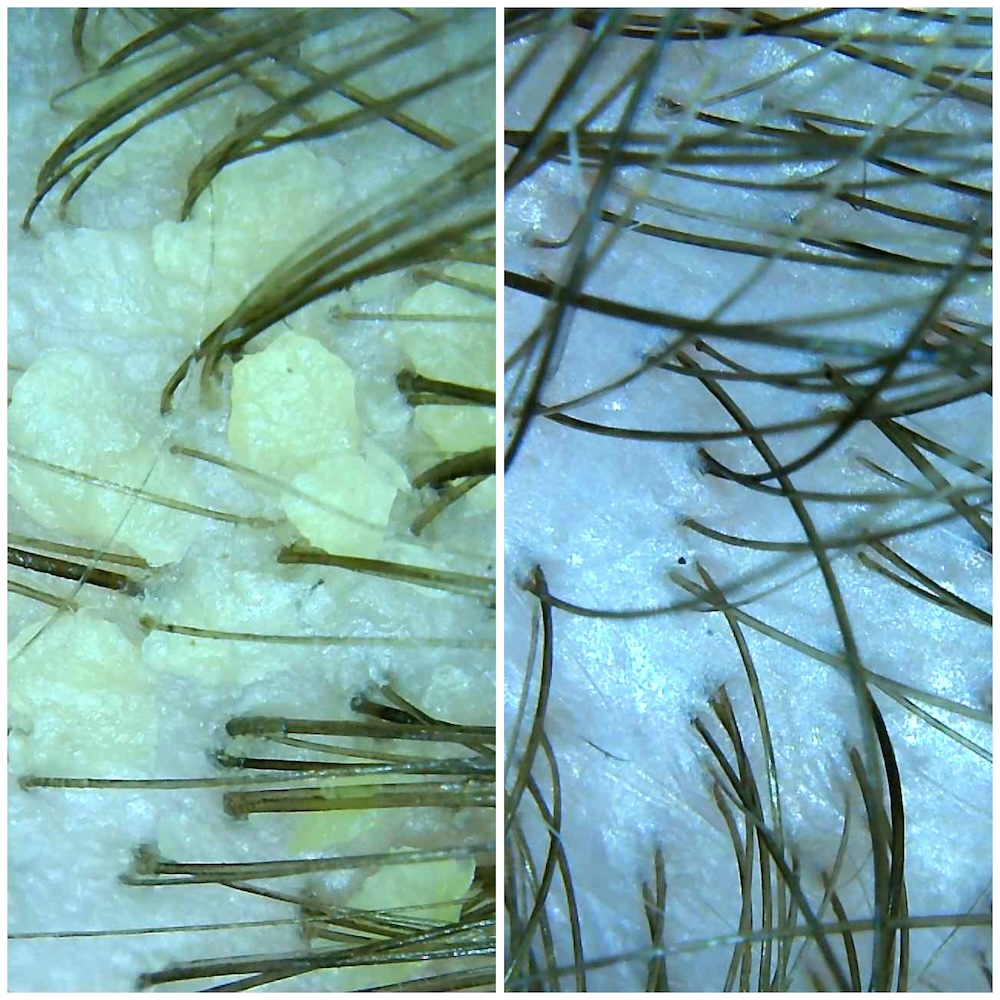 Vyšetrenie vlasovej pokožky